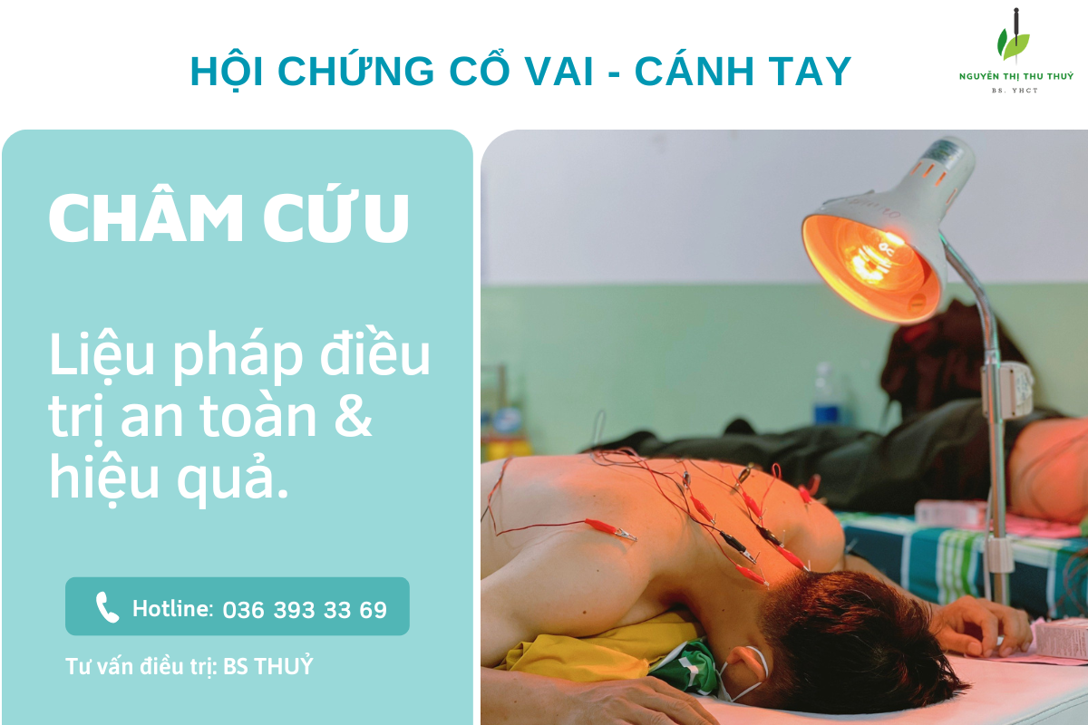 cham cuu dieu tri hoi chung co vai canh tay