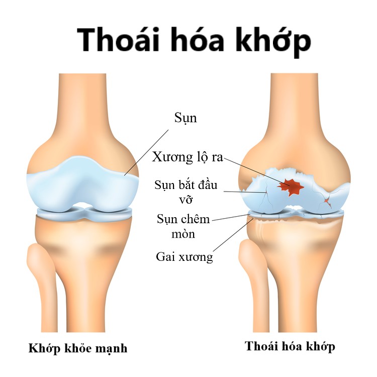 hinh anh thoai hoa khop goi