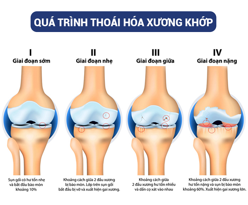 thoai hoa khop la gi nguyen nhan trieu chung cach dieu tri thoai hoa khop