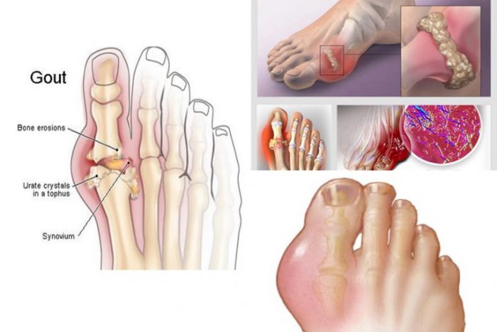 Bệnh Gout (gút) Nguyên nhân chẩn đoán và điều trị