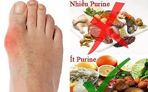 chế độ ăn cho người bị gout