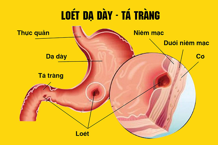 viêm loét dạ dày tá tràng