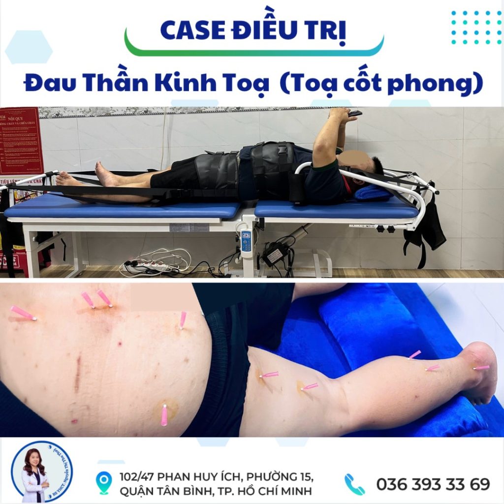 cấy chỉ điều trị thoát vị đĩa đệm