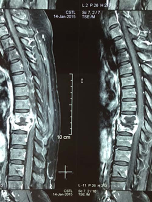 phim MRI lao cột sống