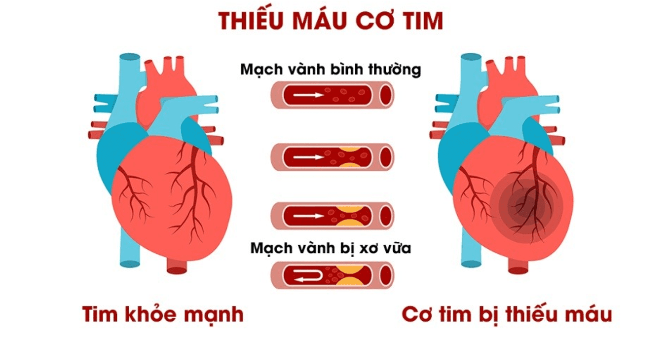 thieu mau co tim