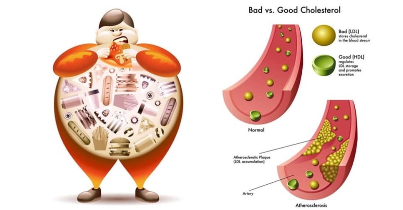 nguyên nhân gây tăng lipid máu