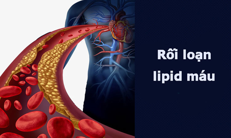 roi loan lipid mau