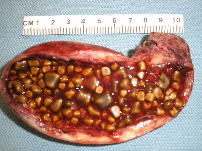 sỏi mật cholesterol