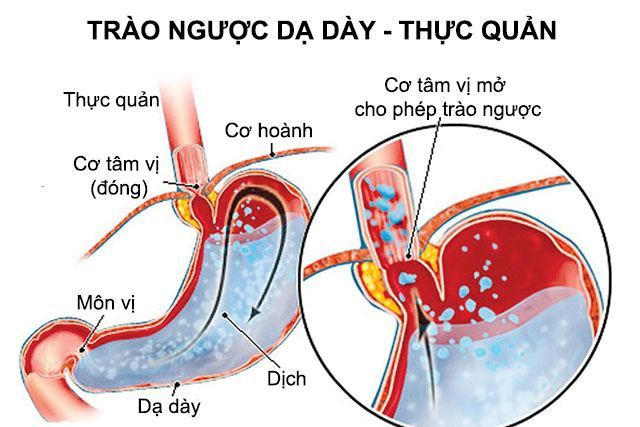 trào ngược dạ dày thực quản