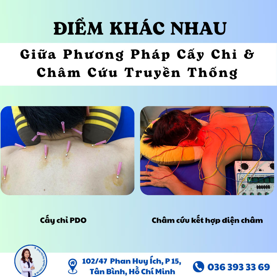 Sự Khác Nhau Giữa Phương Pháp Cấy Chỉ Và Châm Cứu Truyền Thống